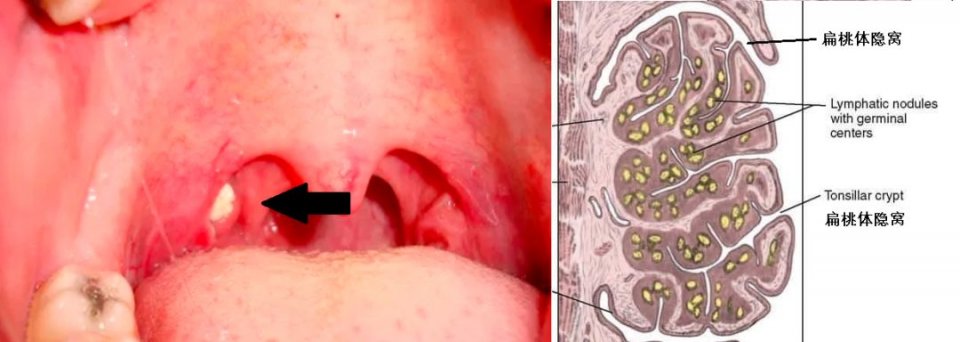 上图左侧黑色箭头是扁桃体结石,右侧是隐窝