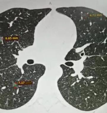 肺多发结节术后，剩余磨玻璃结节能吃靶向药消掉吗？很多患者做完肺多发结节手术，切了