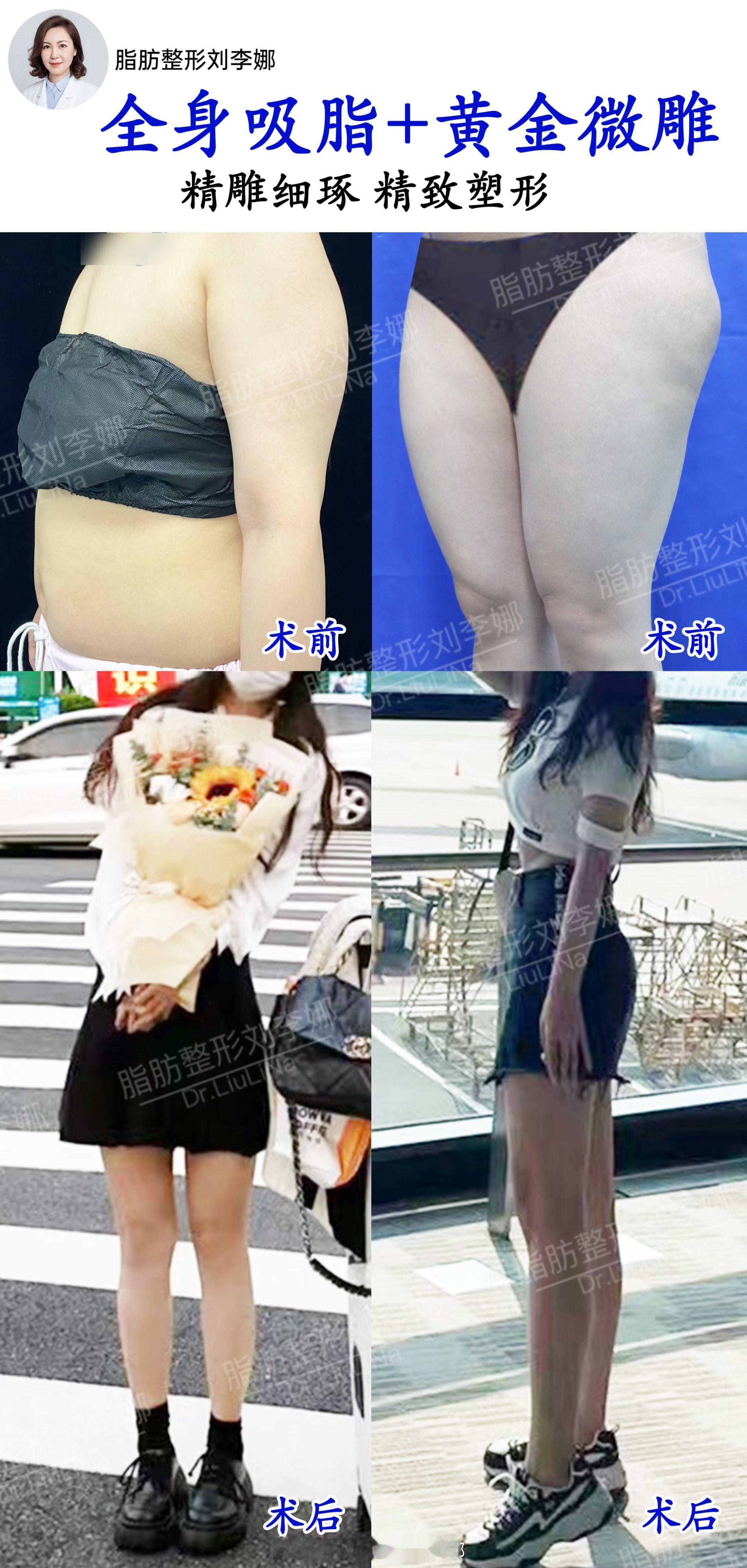 脂肪整形刘李娜手臂吸脂腰腹吸脂美女为产后全身性肥胖，努力尝试了减肥，但是都以失