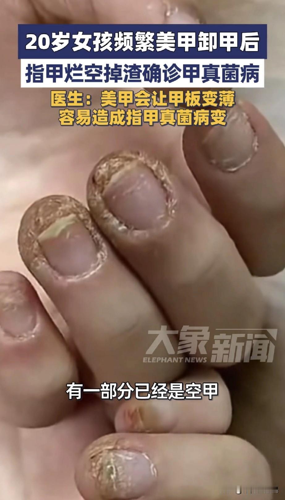 刚刷到个新闻，20岁女生频繁美甲卸甲，指甲直接烂空掉渣，还确诊了灰指甲（甲真菌病