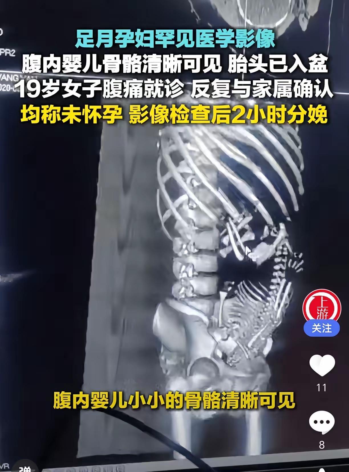 ​19岁女子腹痛去医院，医生反复跟她和家属确认是否怀孕，都得到否认答复。可影像检