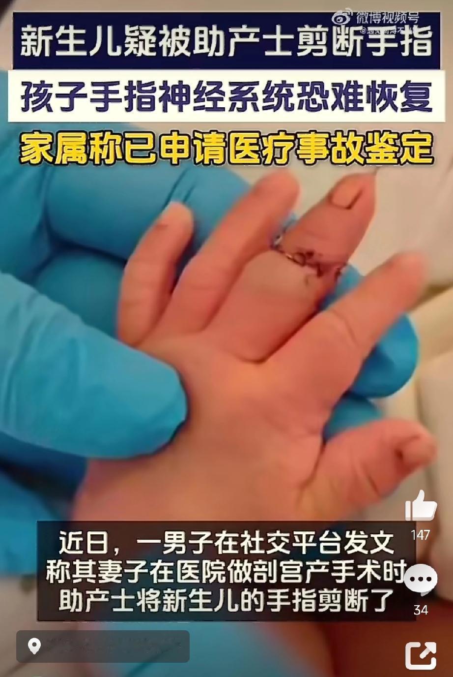 江苏被剪断手指婴儿后续：1、已手术接上断指，植入钢针，孩子因疼痛持续哭闹。