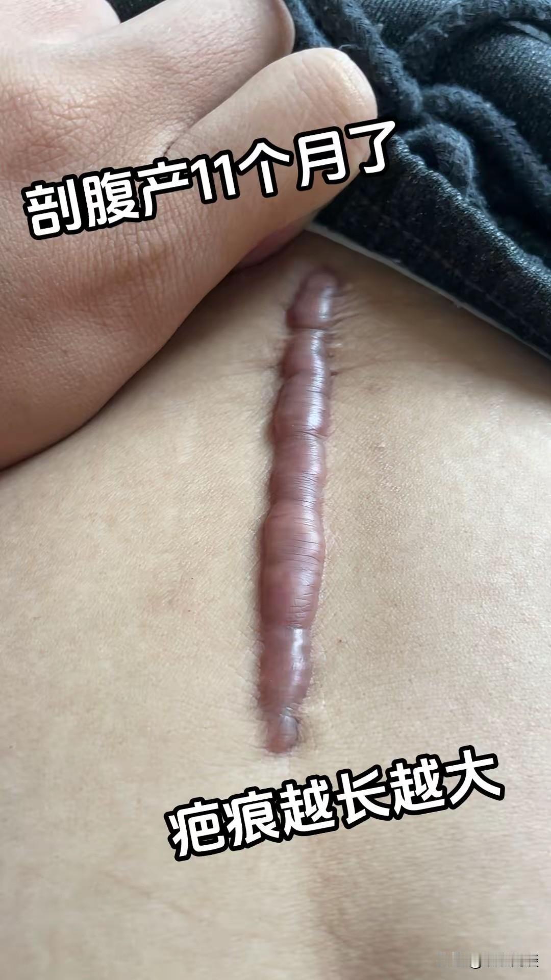 做完剖腹产十一个月，疤痕还是会偶尔疼、偶尔发痒，而且疤痕还越长越宽，有没有同款剖