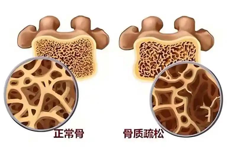张大妈今年57岁，前段时间查出骨质疏松，听人说芝麻补钙，就天天早晚冲芝麻糊喝