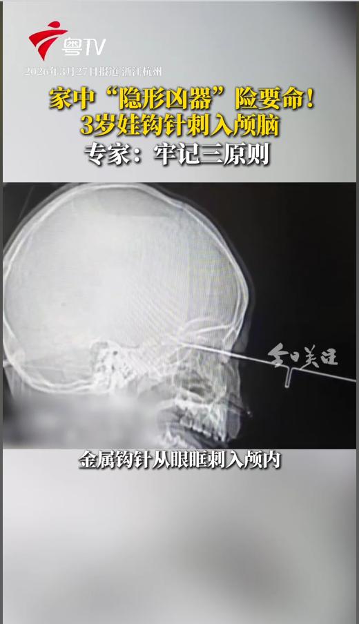 “悲剧还是发生了！”近日，浙江，一位3岁的宝宝在玩钩针的时候，不小心被它扎进了大