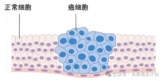 如何判断一个癌症患者能活多久? 寿命长短重点看这3点就足够!