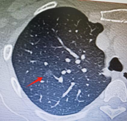 肺结节术后是“微浸润癌”的案例。这位患者52岁，平时生活习惯挺好，也不抽烟，没什