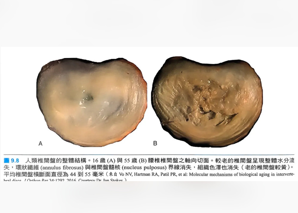 一个腰椎间盘的小常识：很多人的体检报告，会显示“椎间盘退变”“椎间盘变薄”“椎间