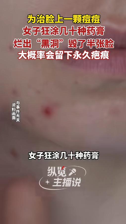 “真是个狠人！”5月19日报道，浙江杭州，一女子脸上长了个硬疙瘩，她以为是个痘，