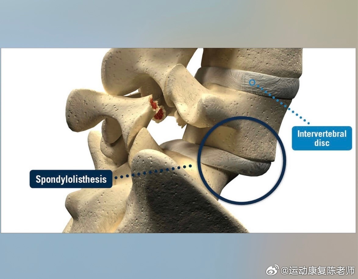 腰痛【腰痛康复】前几天讲了椎管狭窄，关于腰椎还有两个损伤概念——腰椎峡部裂与腰