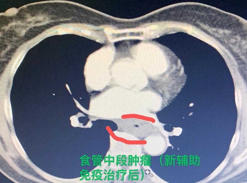 这几天心情确实有点复杂，喜忧参半吧！开心的部分，是看到我的几位病人恢复得特别好。