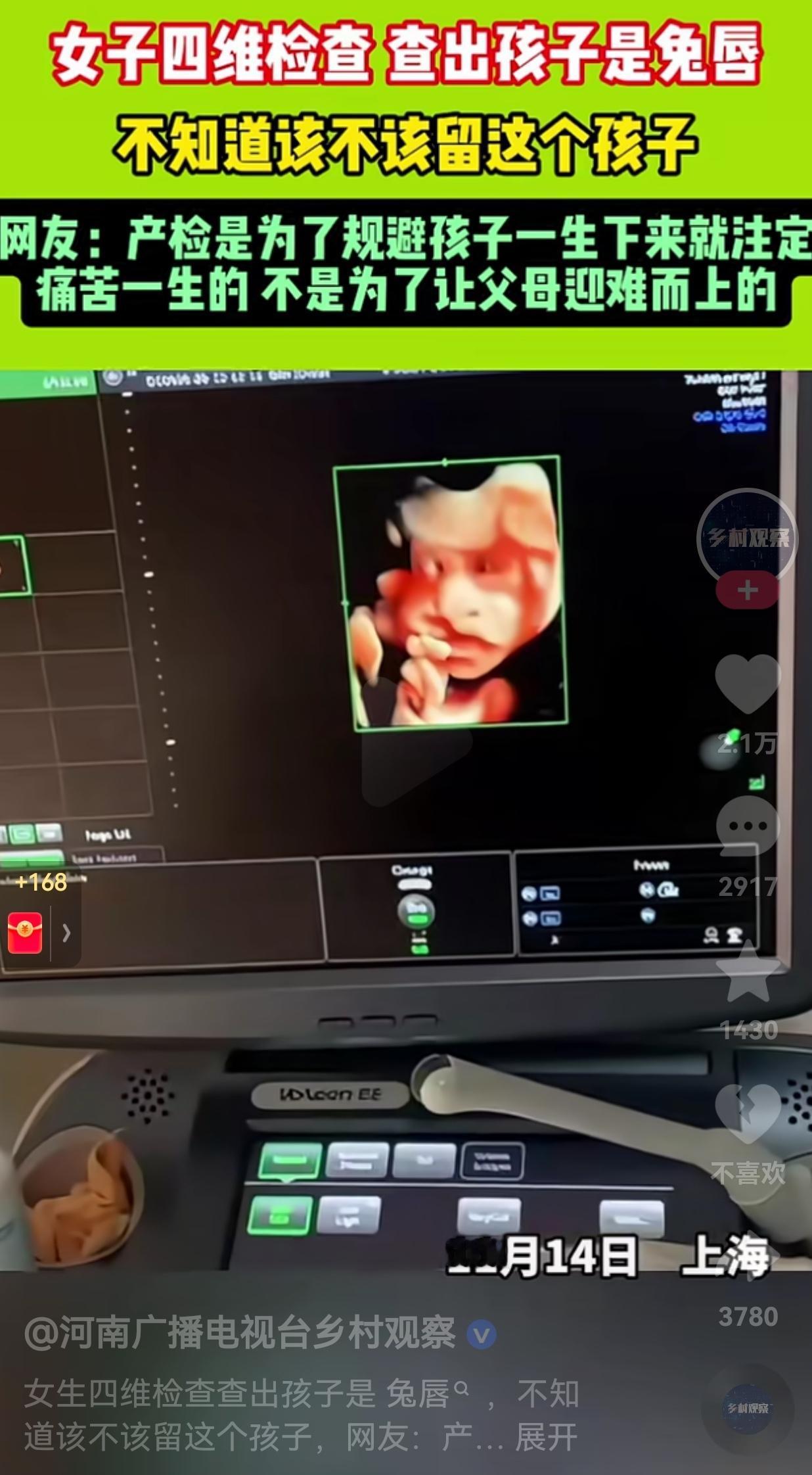 如果是你，你会怎么做？上海一女子做四维检查的时候，查出孩子是兔唇。当孕妈妈知