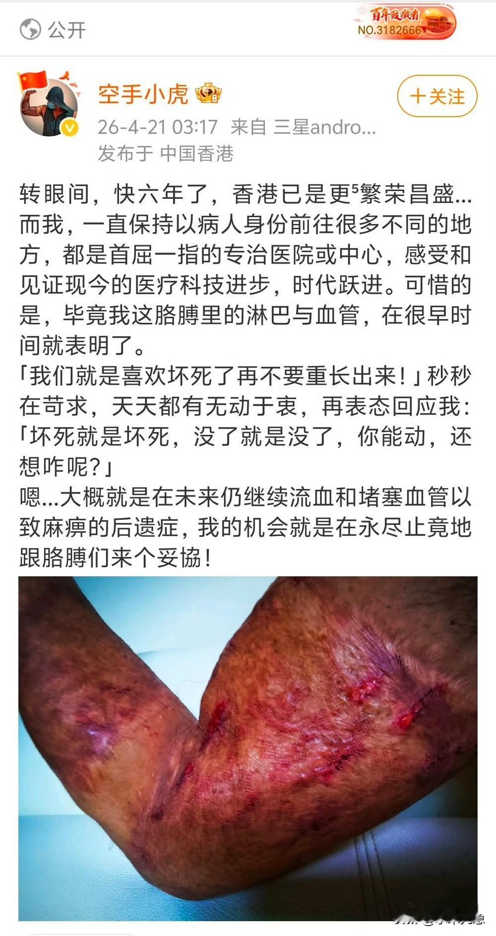 这是黑暴时期，国庆执勤被泼上腐蚀性液体，造成胳膊严重创伤的香港警察小虎。六年