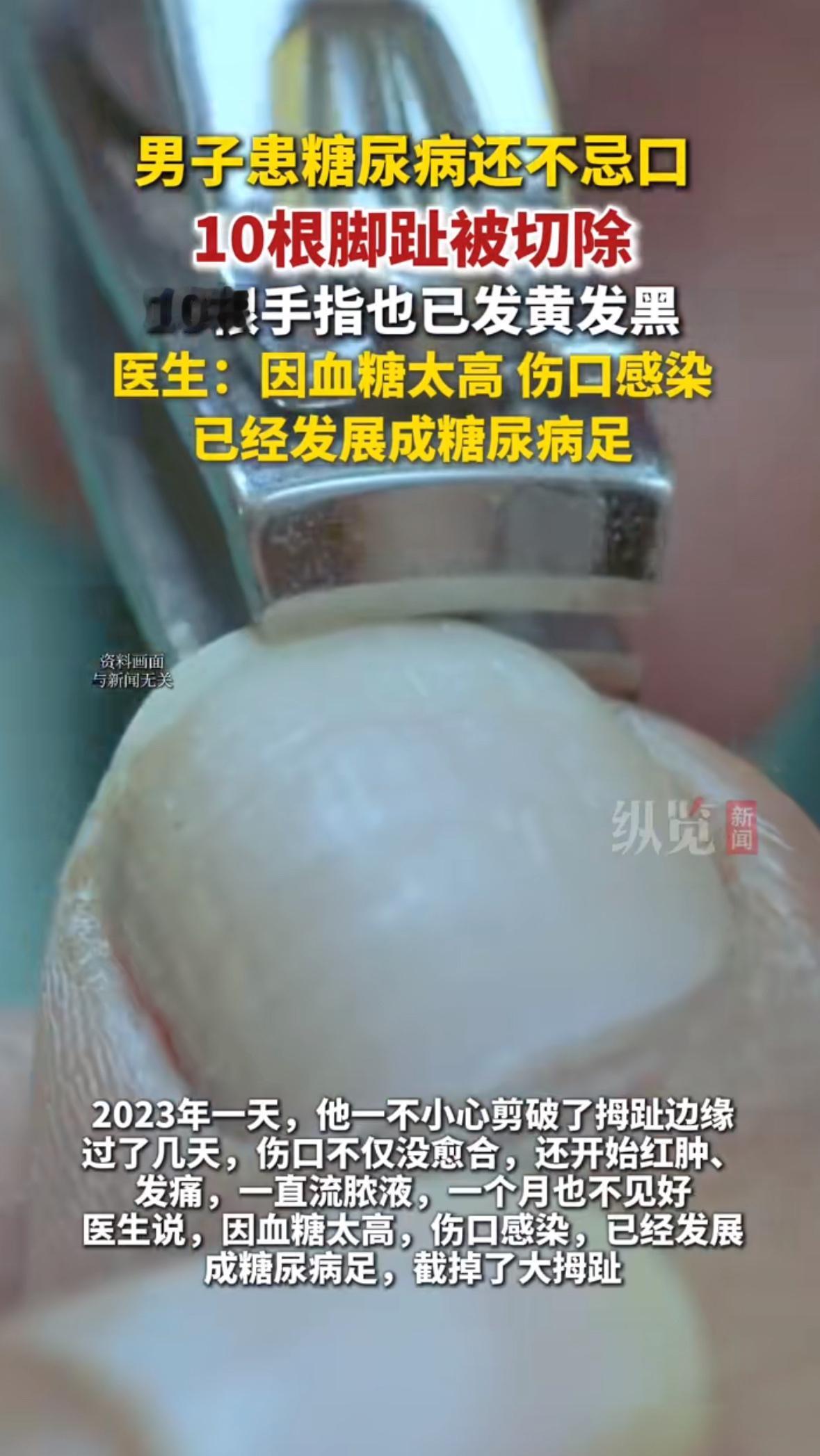 “不就是剪个脚趾甲破点皮吗？至于截肢？”当65岁的陈建国躺在病床上，看着空荡荡的