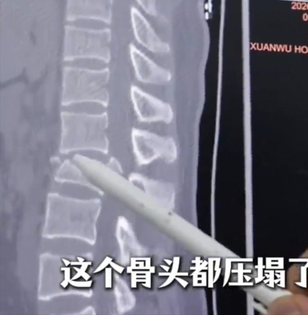 北京25岁女子在医院醒来，双腿没知觉，大小便也控制不住。医生无奈告诉她，腰椎摔爆