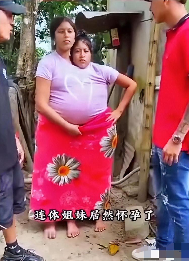 太神奇了。这是国外的一个连体姐妹，结婚后竟然怀孕了。网上吵翻了有人说“不该生”