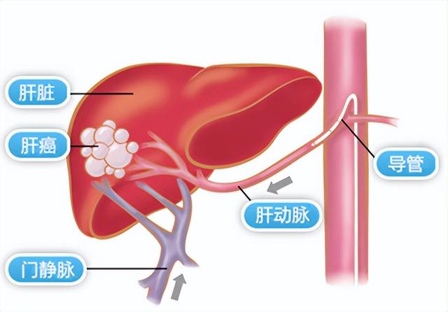 穿刺活检会导致癌细胞扩散转移到其他地方吗?