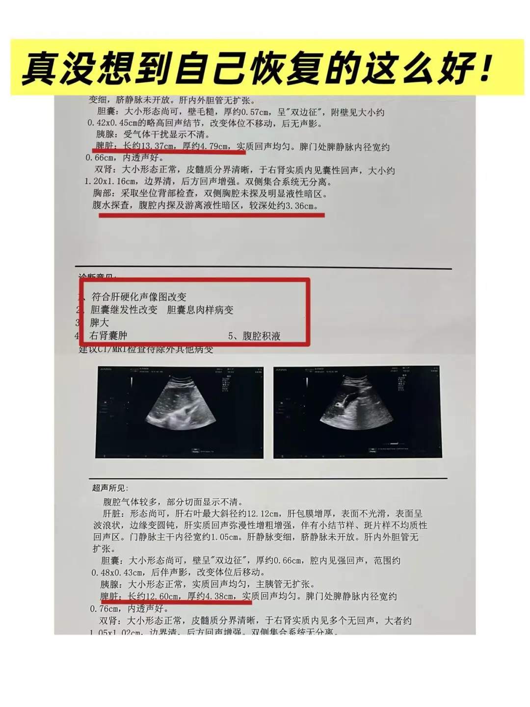 “真没想到自己还能恢复得这么好！”肝硬化失代偿期患者，脾大...