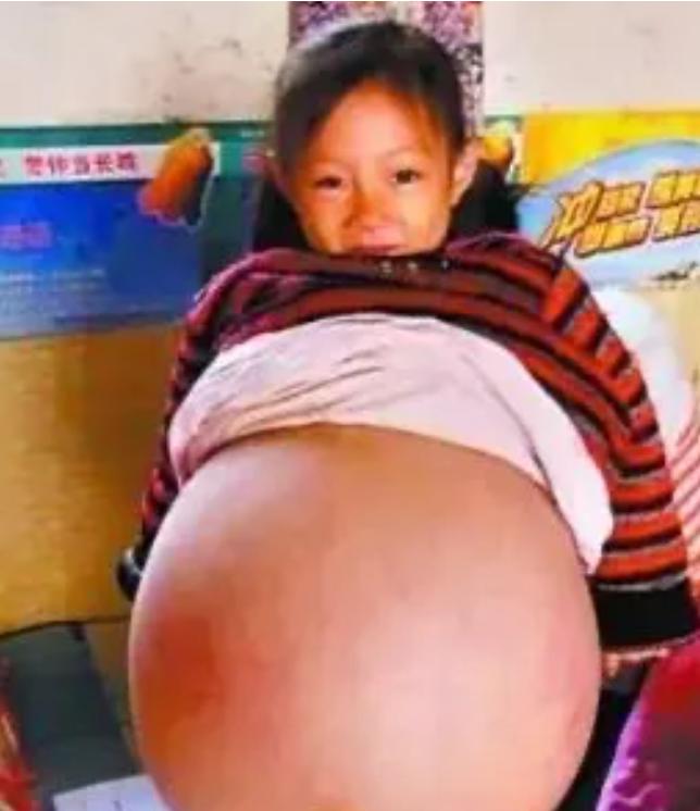 2010年，山西4岁女孩胡云星，肚子超大鼓胀得像孕妇。医生预言活不过三个月，就在