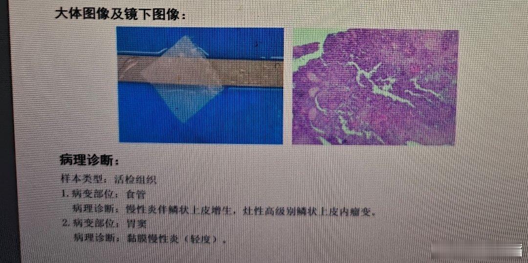 上周发现的食管早癌，NBI还是很实用，扫过去，茶褐色改变就需要警惕了。特别是食管