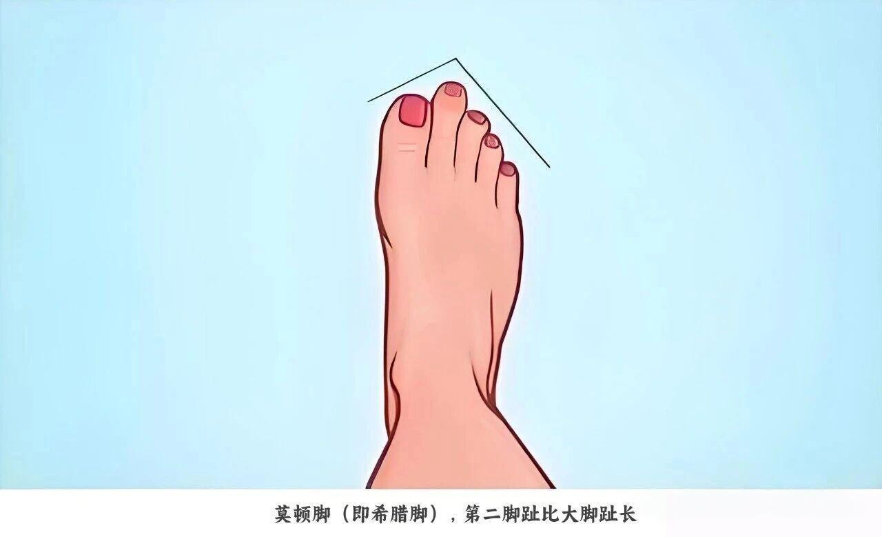 说真的，不少人都有“第二脚趾比大脚趾长”的脚型，这在医学上叫莫顿脚，也叫希腊
