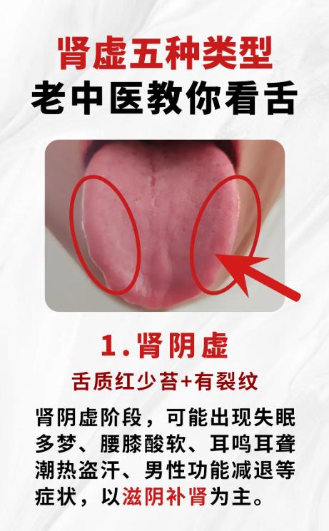 5种肾虚舌象，别再只当单一肾虚了