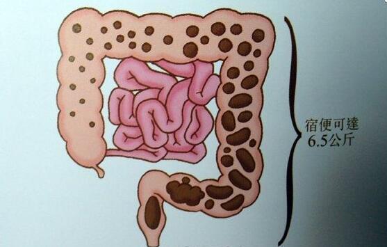 人体宿便有13斤? 清肠排宿便, 1个方法很有效!