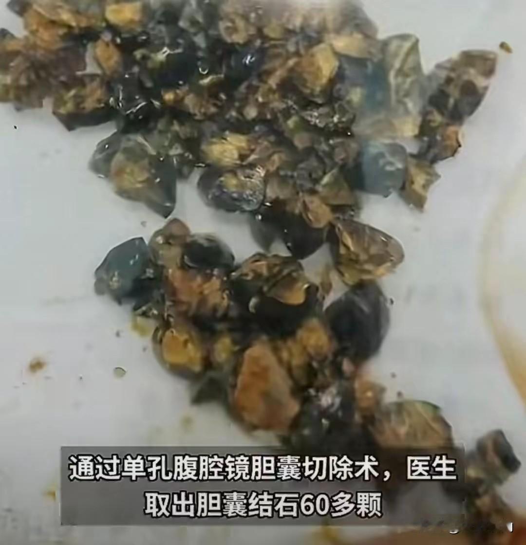 南京女子腹痛手术取出60多颗结石，医生只说一句警示南京35岁王女士长期不吃