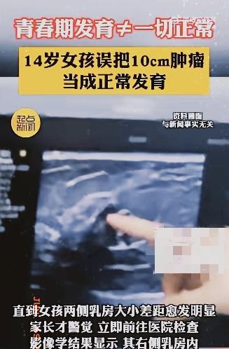 太吓人了！6月16日报道，西安，14岁初二女生洗澡时无意摸到右侧乳房有个硬块，像