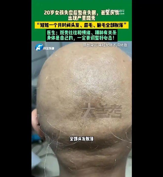“太心疼了！”河南郑州的20岁女孩，洗头发的时候发现她头发的大量脱落，甚至眉毛和