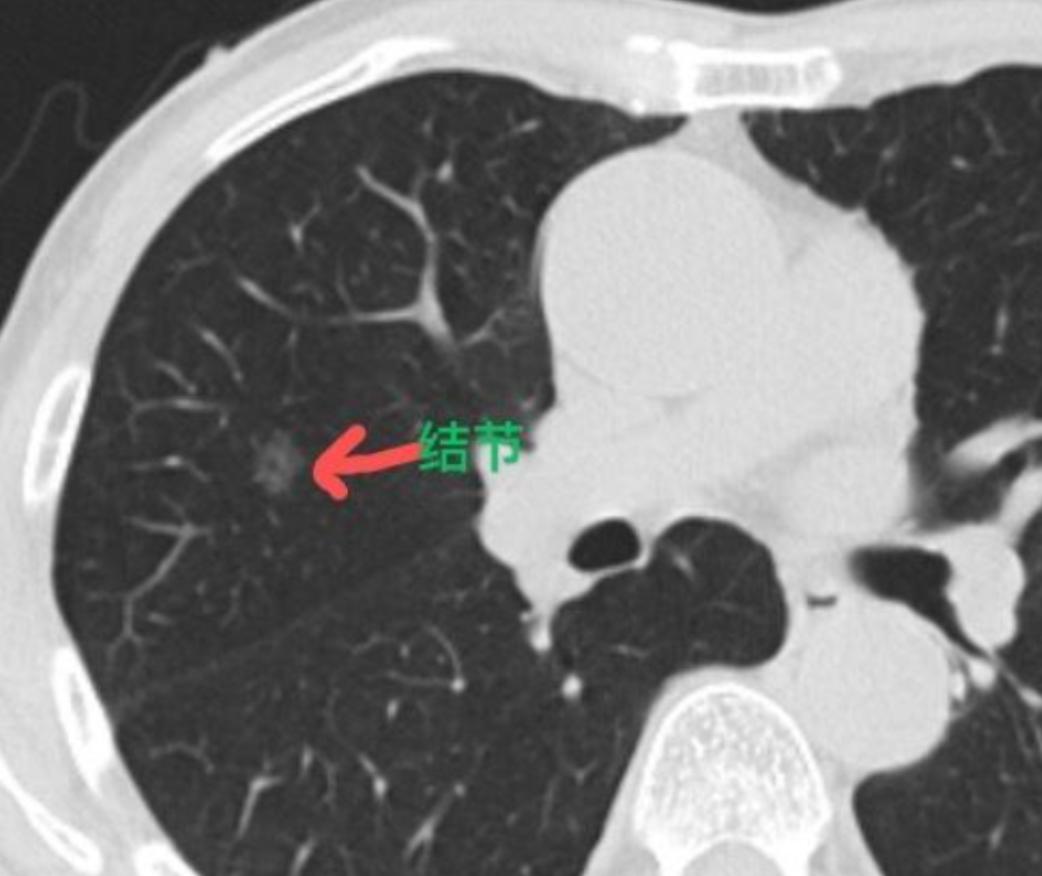 这位男性患者35岁，在体检中发现右肺有一个磨玻璃结节，已经随访快一年了，大小和形