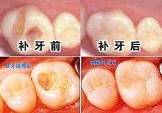 补牙前后的注意事项有哪些? 你应该知道
