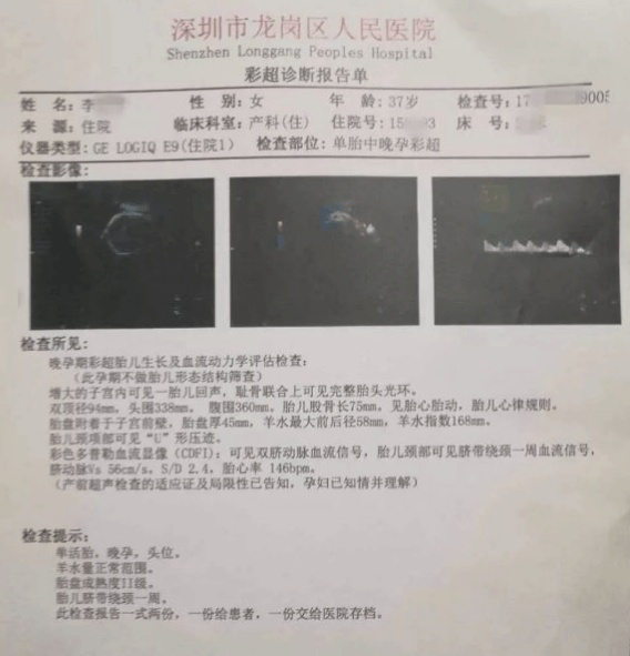 谁之过? 高龄产妇顺产时胎儿死亡