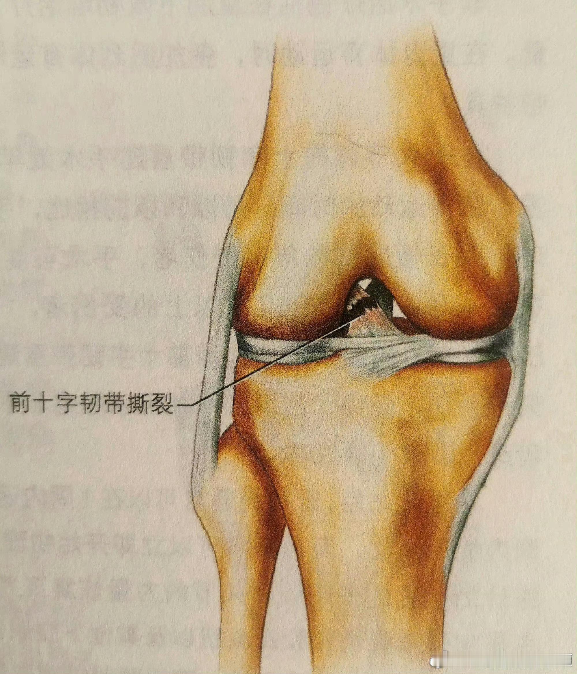 半月板不知道你们有没有听说过——“魔鬼三联征”？👉🏻这个损伤是指，我们的前
