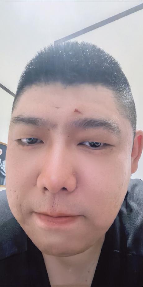 孙九香晒受伤照，成都首演挂彩，观众透露磕桌子上了！德云社孙九香深夜发文，晒出了一