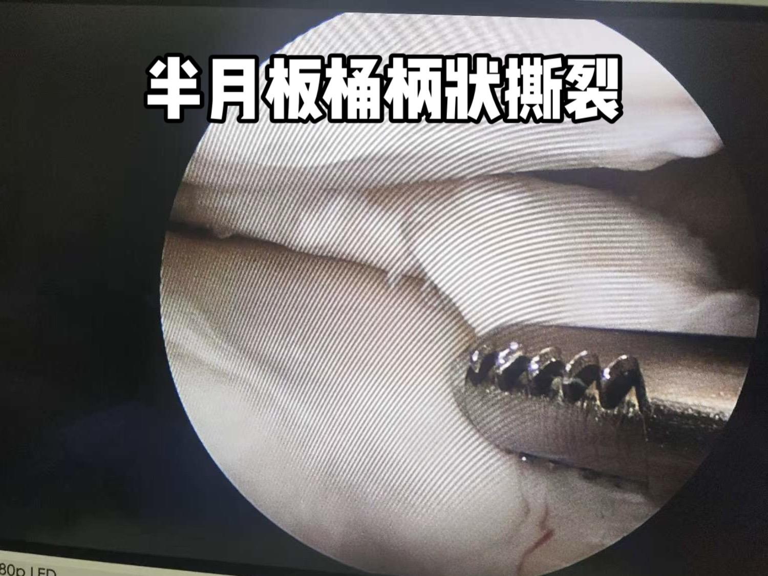 半月板撕裂类型之一。