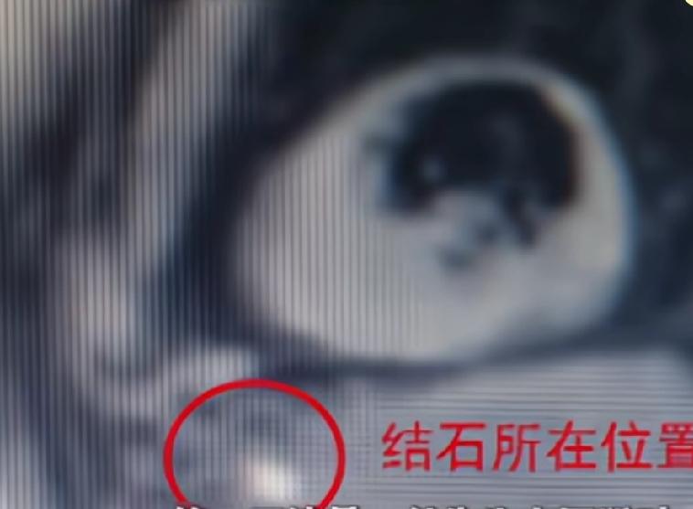 六毫米结石堵住输尿管，27岁男子手术前夜自行排石，他又蹦又跳，甚至拿筋膜枪对