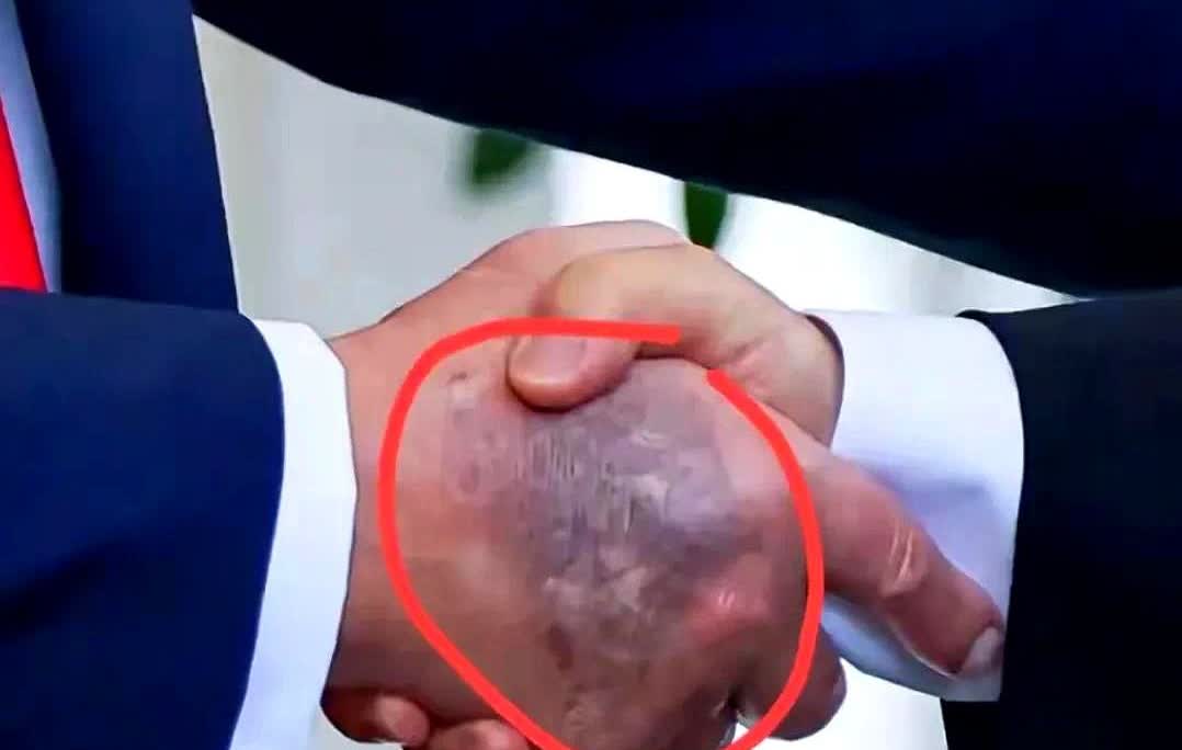 手背黑紫，特朗普和李在明一握，镜头定格。网友放大：不是阴影，是皮下出血。有人