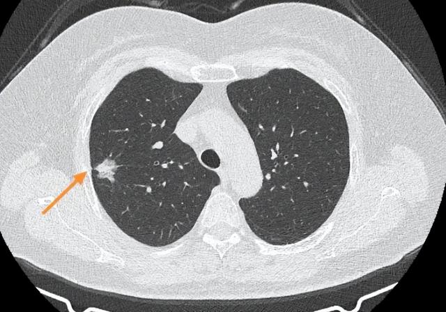 CT报告上出现这些字眼, 通常是肺结节的恶性特征, 要足够重视!