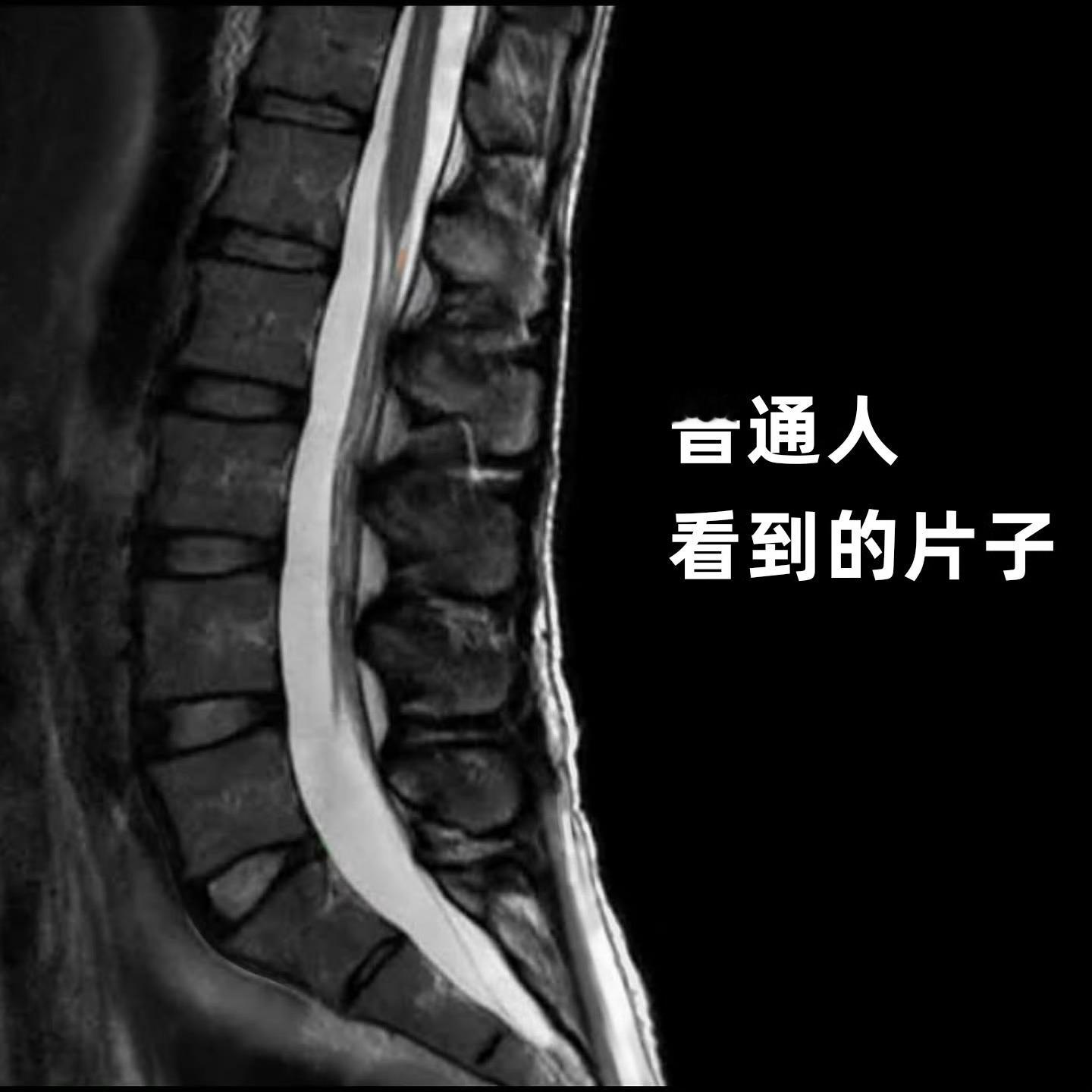 腰椎间盘突出经典对比图，来带你认识“真实”的腰椎拍过核磁片子的朋友，有没有看到