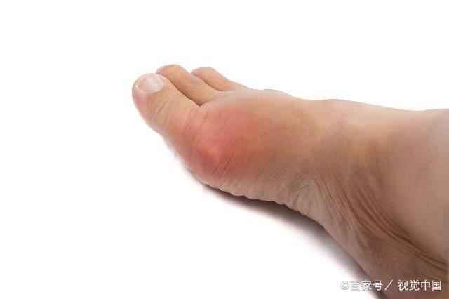 痛风“天敌”终于被发现, 每天喝一杯, 高尿酸不攻自破, 痛风没了