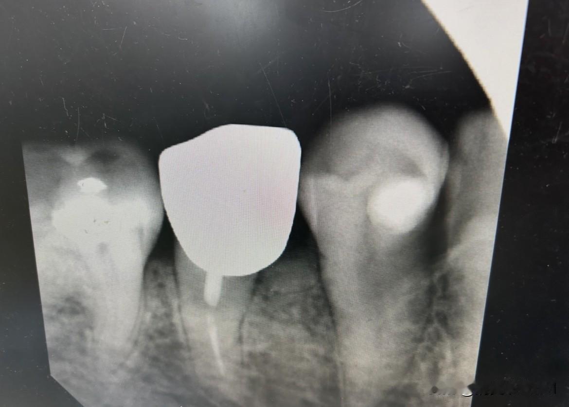 种牙和拔牙哪个更疼?我的牙从补牙到打桩镶牙冠，再到桩子折牙冠脱落，历经8年，现