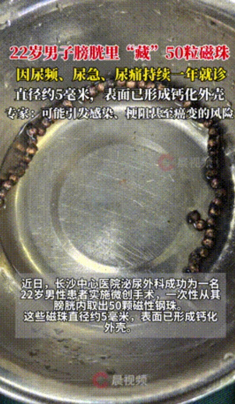 太狠了！湖南，22岁男子因尿频尿痛长达一年就医，医生检查后发现他膀胱内“藏”了5