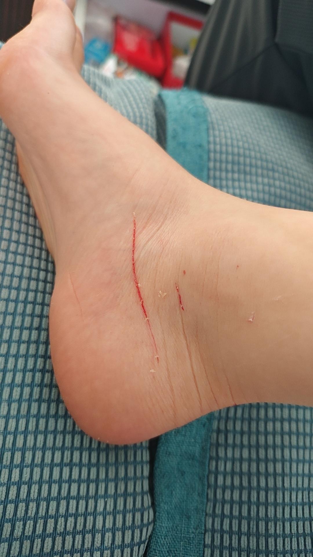 今天儿子被自家猫十月给抓了，实在不放心还是带孩子去打了狂犬疫苗，一晚上就花了40