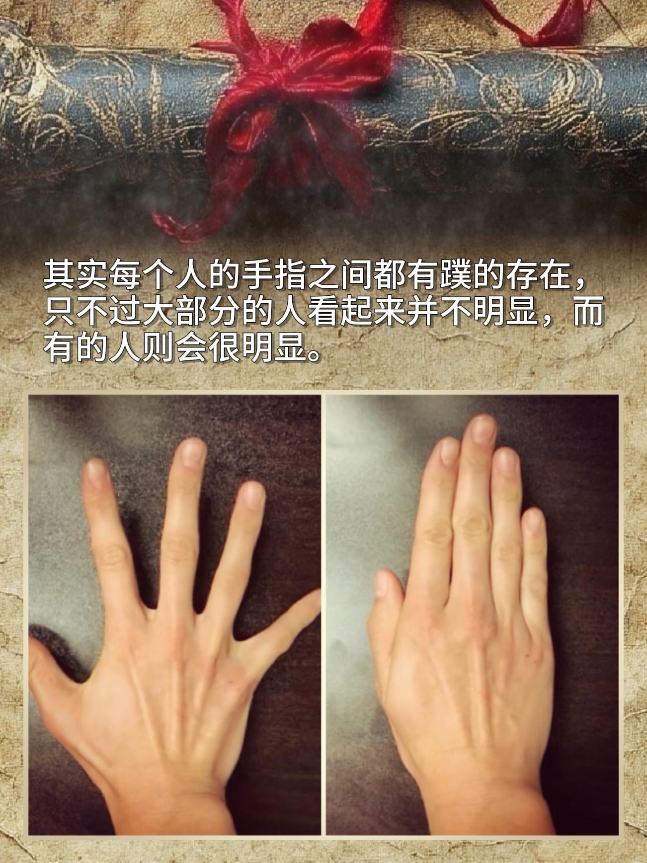 其实每个人手指间都有蹼的，只是大部分人看起来不明显，有的人才会特别突出