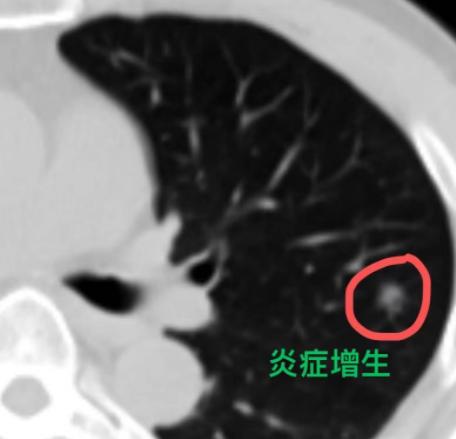 经常有患者这样问我：良性的肺结节以后会不会慢慢变成肺癌？要不要趁早做手术，把它切