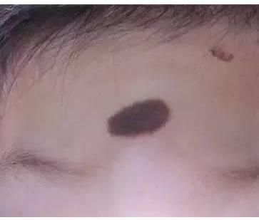 不可忽视的新生儿胎记, 家长们要及时发现