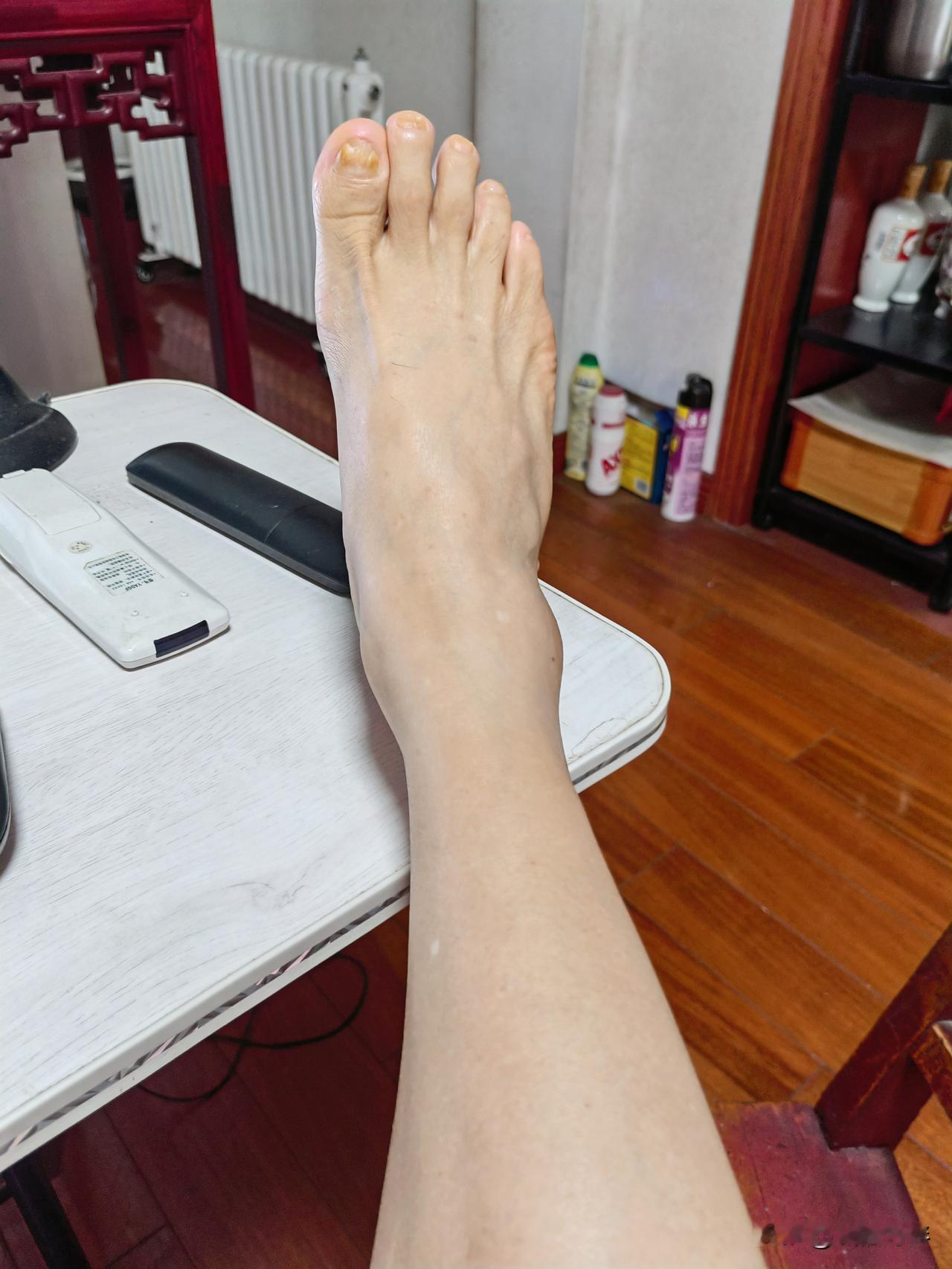 73岁单身老男人小腿上的静脉曲张，经过最近半个多月，上午一次，晚上一次的自我按摩
