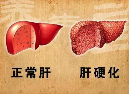 想要把肝硬化给控制住，其实并不难，给大家说一个好消息如果你不想让肝硬化继续进