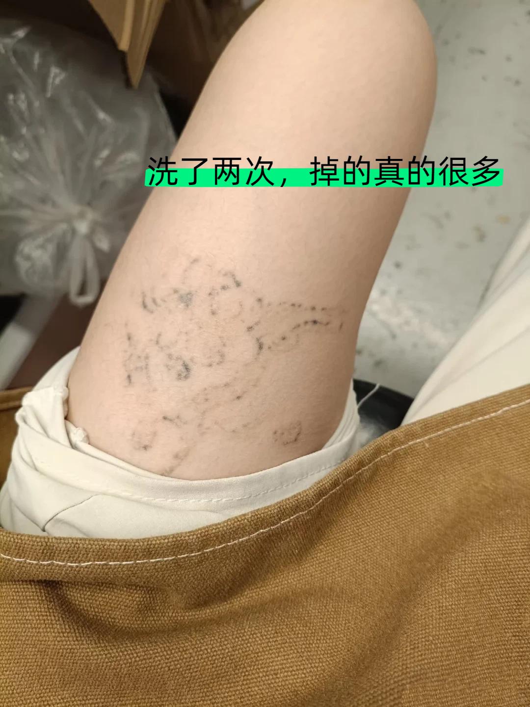 第二次洗纹身 还是先在海源锐疤痕纹身修复中心的 这一次的感觉和上次感觉...